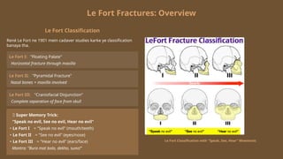 Fort Classification Management_of_Mid_Face_Fractures OS.pptx