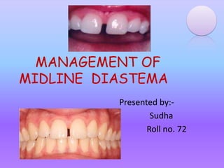 MANAGEMENT OF
MIDLINE DIASTEMA
          Presented by:-
                  Sudha
                 Roll no. 72
 