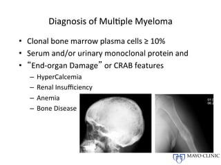Management of Multiple myeloma | PDF