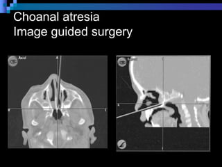 Management of Nasal Obstruction.ppt