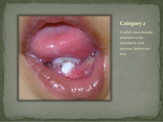 Management of natal and neonatal teeth