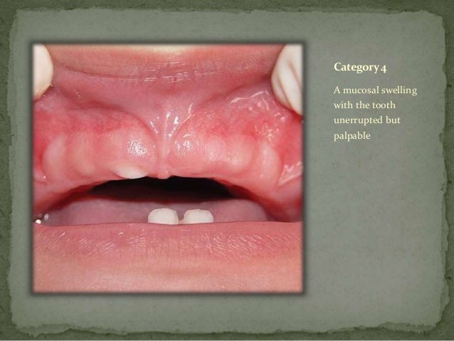 Management of natal and neonatal teeth