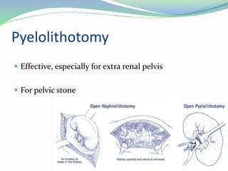 Pyelolithotomy
 Effective, especially for extra renal pelvis
 For pelvic stone
 