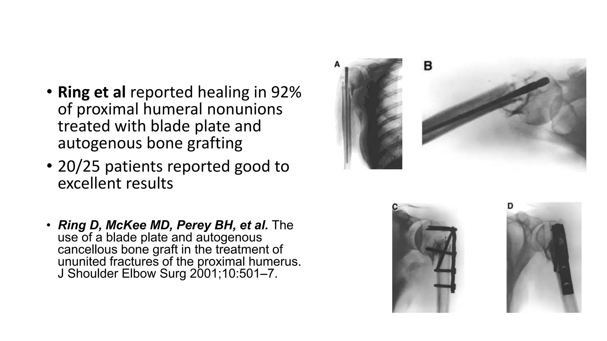 MANAGEMENT OF NONUNIONS AND MALUNIONS OF PROXIMAL HUMERAL FRACTURES.pptx