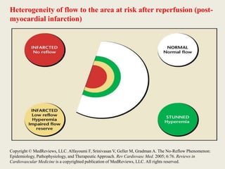 Management of no reflow | PPTX