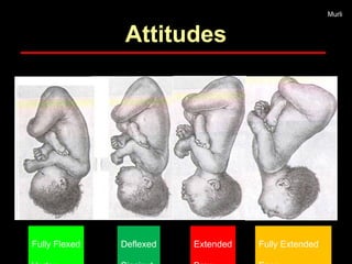 Deflexed Management of normal labor process and pelvis | PPT