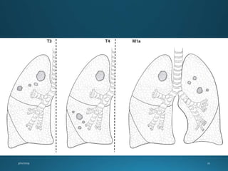 Management of Non Small Cell Lung Cancers | PPTX
