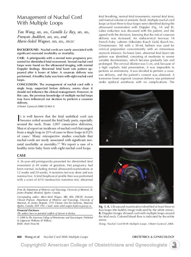 Management of nuchal cord with multiple loops.