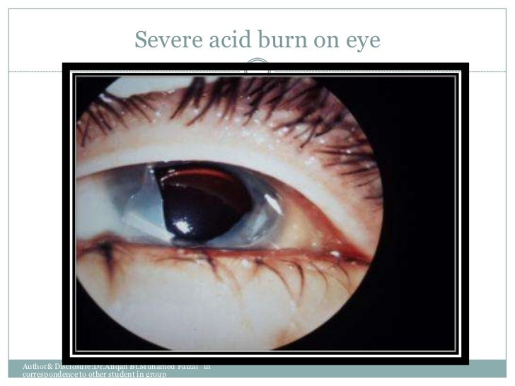 Management of ocular chemical injuries