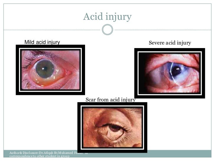 Management of ocular chemical injuries