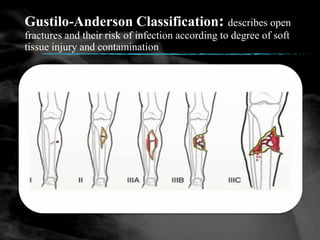 Management Of Open Fracture PDF Management Of Open Fracture PDF