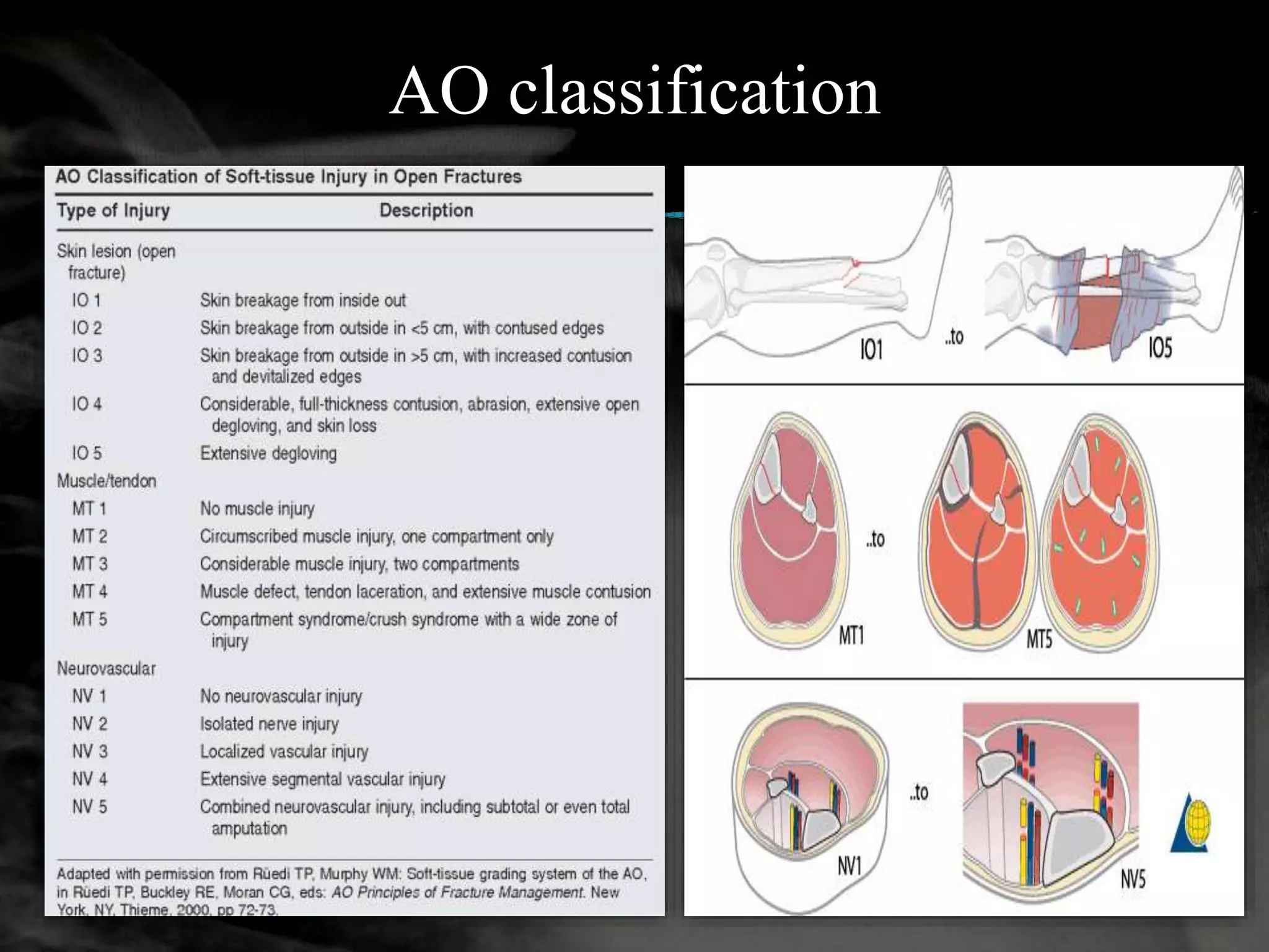 Management of open fracture true ppt | PPTX
