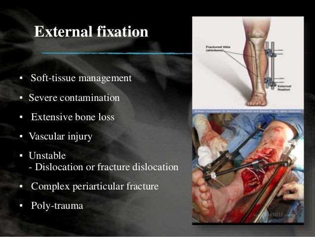 Management Of Open Fracture True Ppt - 