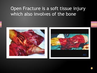 Management of Open Fracture powerpoint ppt | PPTX