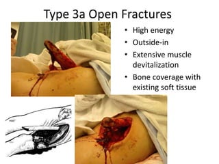 Type 3a Open Fractures
• High energy
• Outside-in
• Extensive muscle
devitalization
• Bone coverage with
existing soft tissue
 
