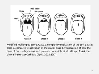 Management of obstructive sleep apnea | PPTX