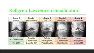 Management Of Osteoarthritis Of Knee By High Tibial pptx