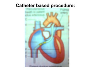 Catheter based procedure: 