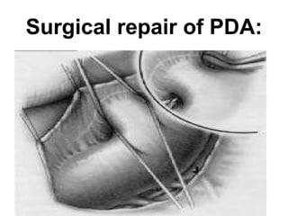 Surgical repair of PDA: 
