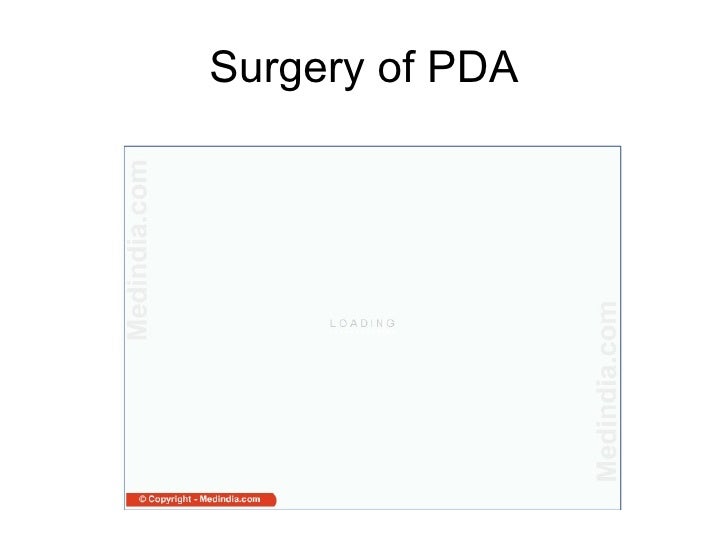 Management Of PDA