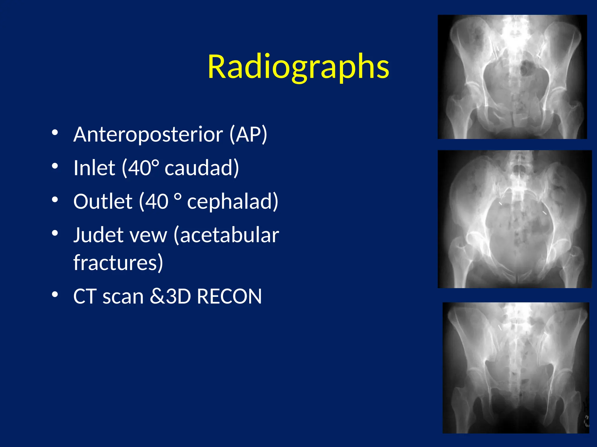 MANAGEMENT OF PELVIC FRACTUREMANAGEMENT OF PELVIC FRACTUREMANAGEMENT OF ...