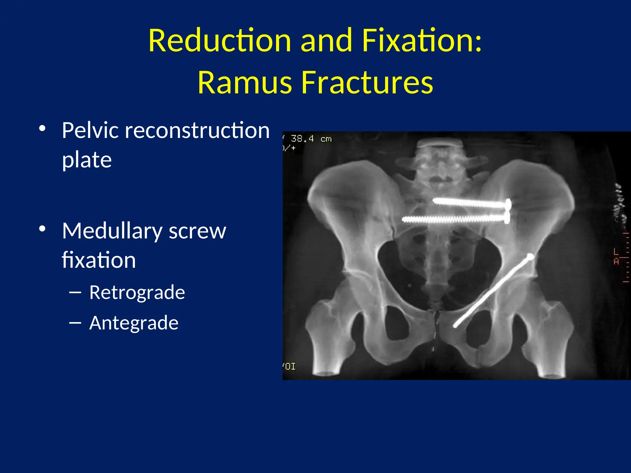 MANAGEMENT OF PELVIC FRACTUREMANAGEMENT OF PELVIC FRACTUREMANAGEMENT OF ...