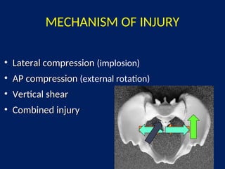 Lateral Compression Text MANAGEMENT OF PELVIC FRACTUREMANAGEMENT OF PELVIC FRACTUREMANAGEMENT OF ...