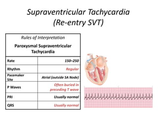 Svt In Normal R R Intervel Management of peri arrest arrhythmias | PPTX