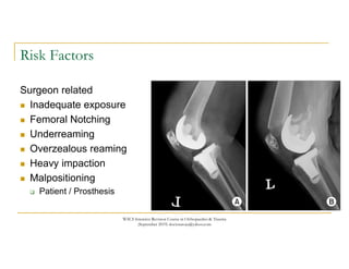 Underreaming Chart Management of peri prosthetic fractures | PDF
