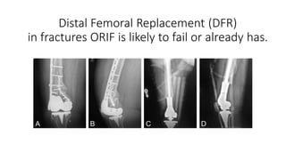 Left Dfr Surgery Management of periprosthetic fracture | PDF