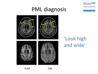 FLAIR DWI
PML diagnosis
‘Look high
and wide’
 