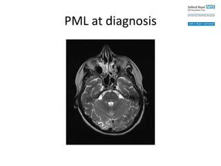 PML at diagnosis
 