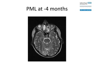 PML at -4 months
 
