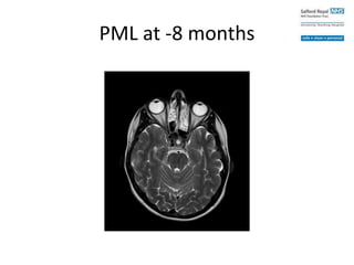 PML at -8 months
 