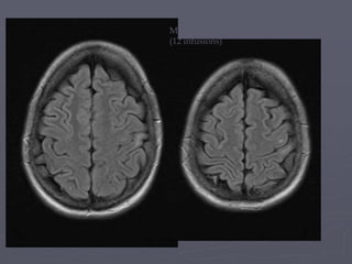 March 23rd 2011
(12 infusions)
 