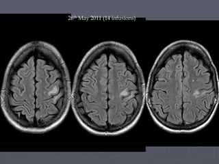 26th May 2011 (14 infusions)
 