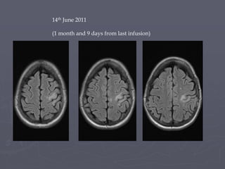 14th June 2011
(1 month and 9 days from last infusion)
 