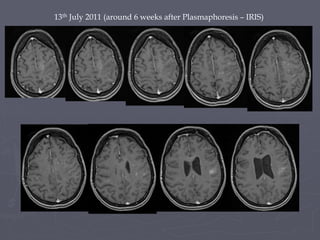 13th July 2011 (around 6 weeks after Plasmaphoresis – IRIS)
 