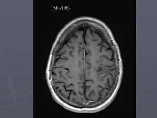 PML/IRIS
 
