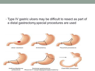 • Type IV gastric ulcers may be difficult to resect as part of
a distal gastrectomy,special procedures are used
 