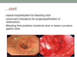 …cont
• repeat hospitalization for bleeding ulcer
• concurrent indications for surgery(perforation or
obstruction)
• Bleeding from posterior duodenal ulcer or lesser curvature
gastric ulcer
 