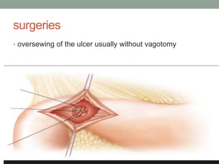 surgeries
• oversewing of the ulcer usually without vagotomy
 