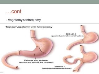 …cont
• Vagotomy+antrectomy
 