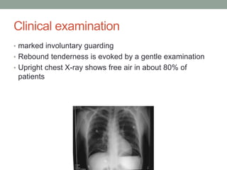 Clinical examination
• marked involuntary guarding
• Rebound tenderness is evoked by a gentle examination
• Upright chest X-ray shows free air in about 80% of
patients
 