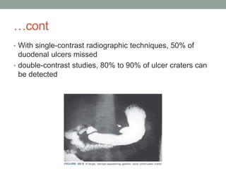 …cont
• With single-contrast radiographic techniques, 50% of
duodenal ulcers missed
• double-contrast studies, 80% to 90% of ulcer craters can
be detected
 