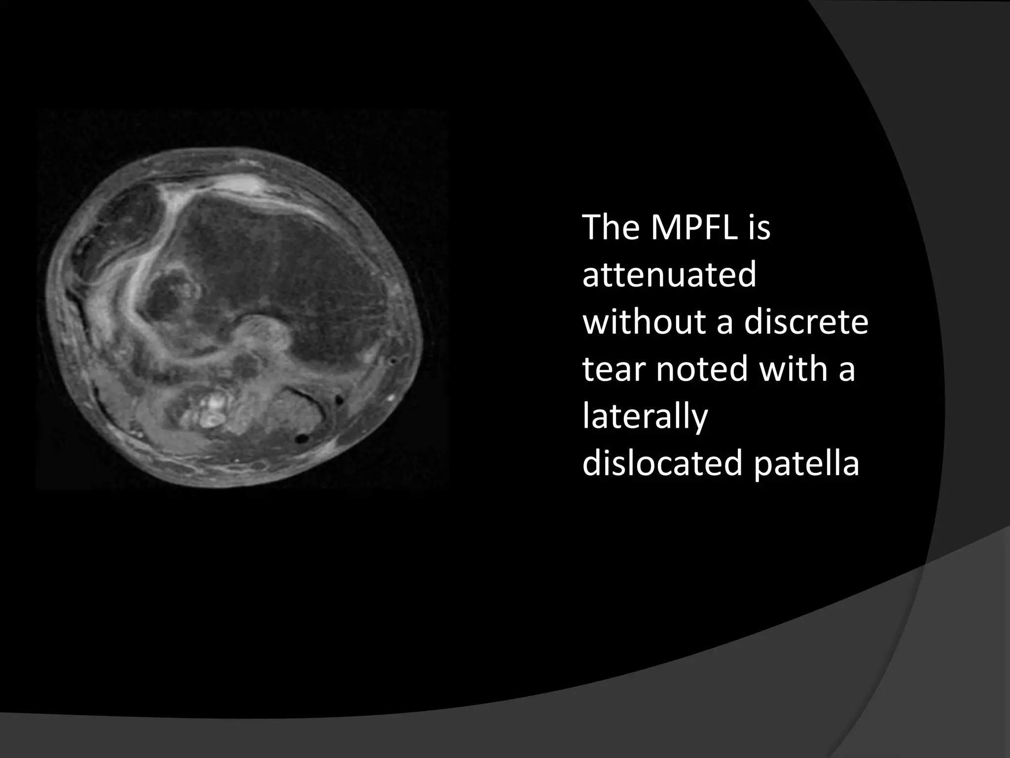 The MPFL is
attenuated
without a discrete
tear noted with a
laterally
dislocated patella
 
