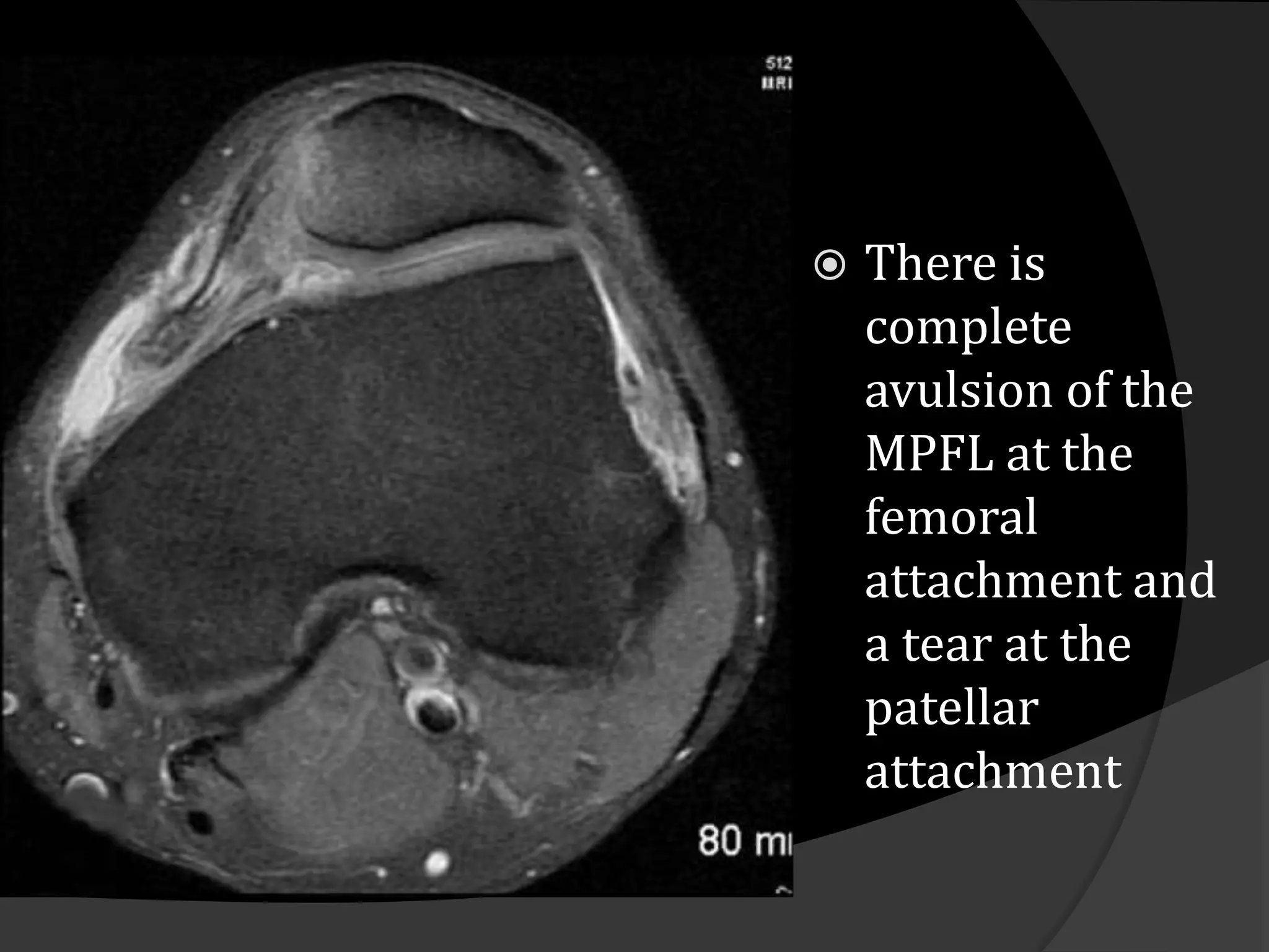    There is
    complete
    avulsion of the
    MPFL at the
    femoral
    attachment and
    a tear at the
    patellar
    attachment
 