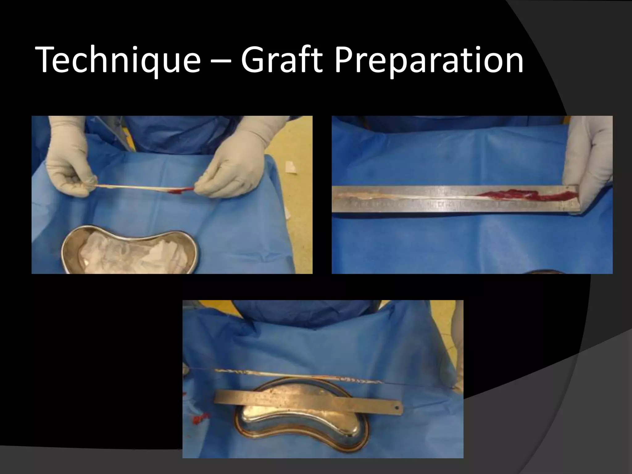 Technique – Graft Preparation
 