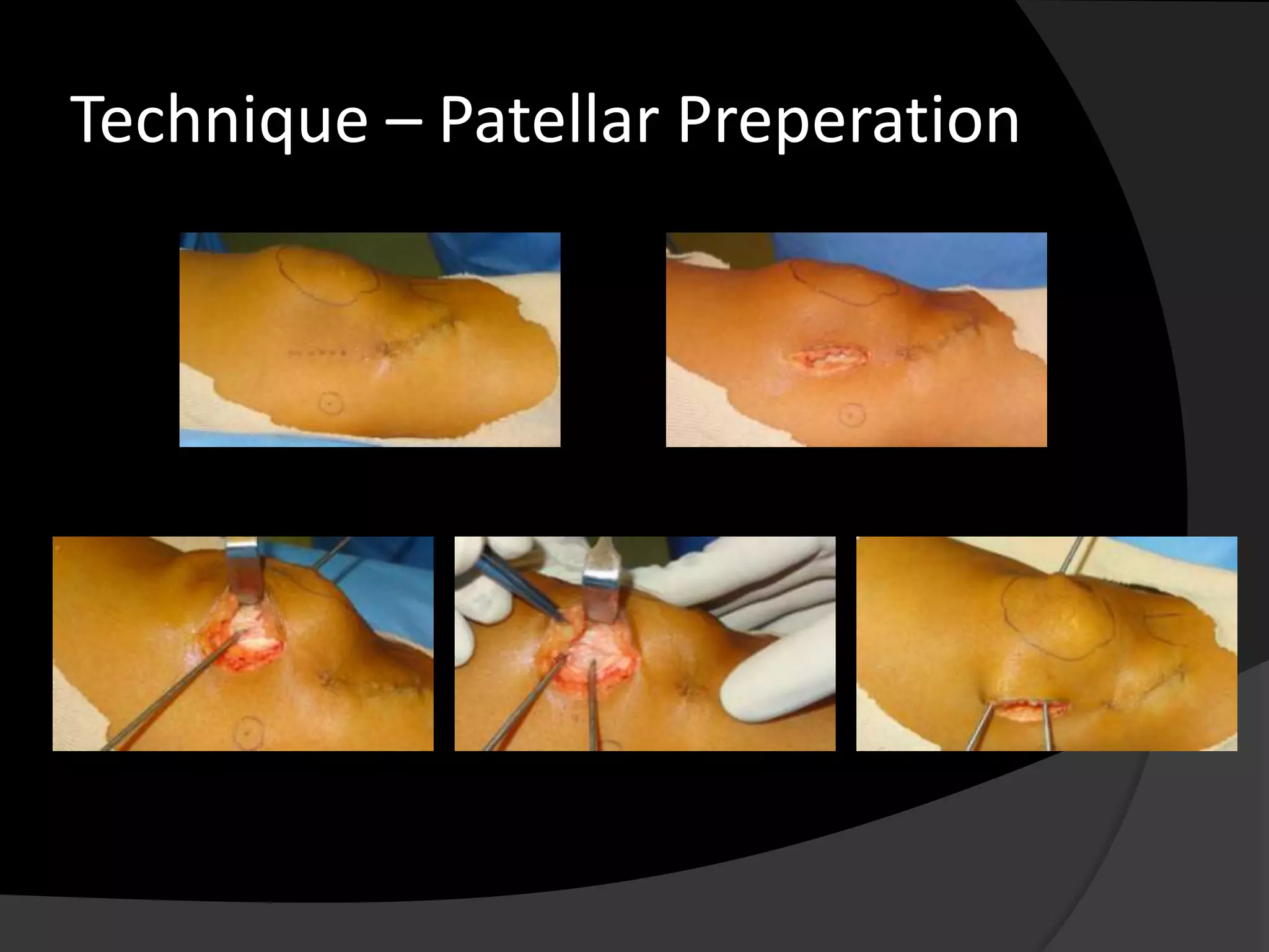 Technique – Patellar Preperation
 