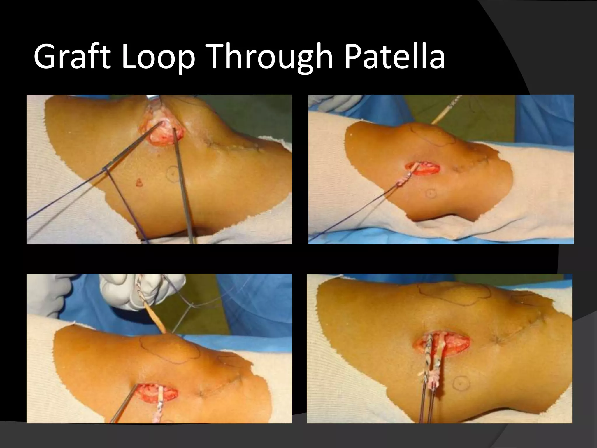 Graft Loop Through Patella
 